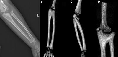 Frontiers | The Relation Between Radiographic Manifestation And ...